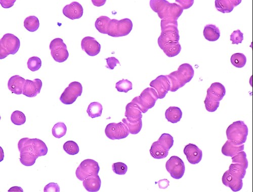 Multiple Myeloma – Rouleaux Formation Microscopic Pathology Image