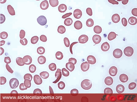 Sickle Cell Anemia – Sickle Cells Microscopic Pathology Image