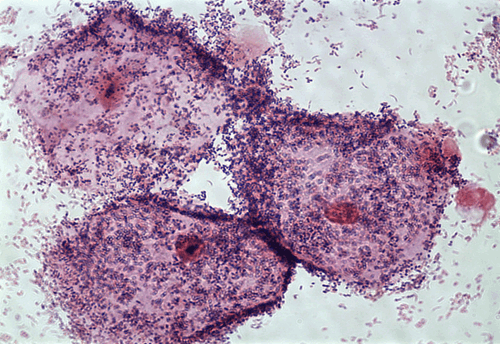 Bacterial vaginosis – Clue cells Microscopic Pathology Image