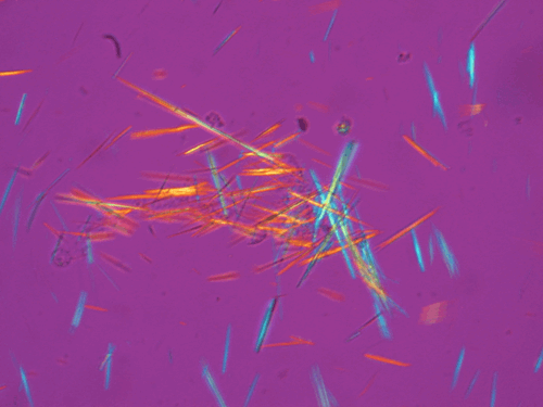 Gout – Monosodium Urate Crystals Microscopic Pathology Image