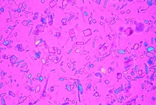 Pseudogout - Calcium Pyrophosphate Dihydrate Crystals Microscopic Pathology Image