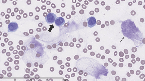 Chronic Lymphocytic Leukemia – Smudge Cells Microscopic Pathology Image